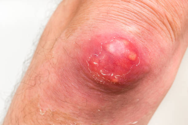 istock Detailed view of elbow with carbuncle or furuncle 882318792