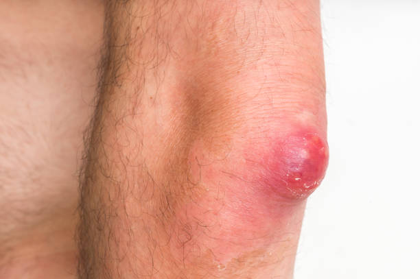istock Detailed view of elbow with carbuncle or furuncle 882319038