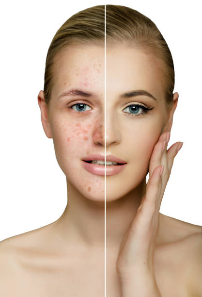 istock female face with clean skin and acne 882477310