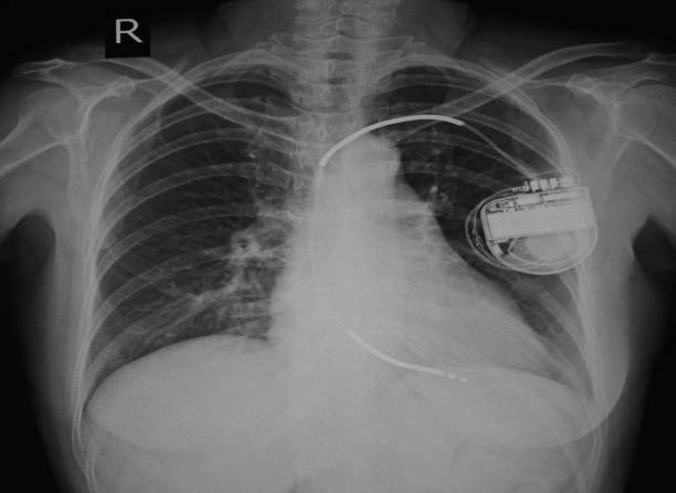 istock X-ray show cadiac pacemaker implant in chest body 882696010