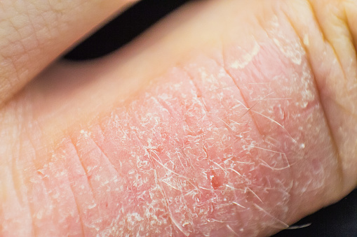 Eczema skin on hand