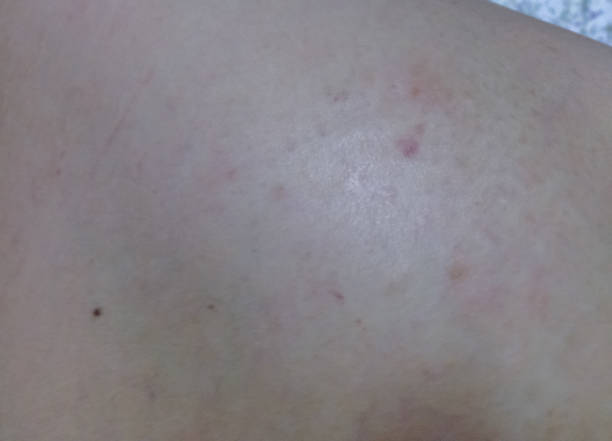 istock Rashes on the skin people. 883613756
