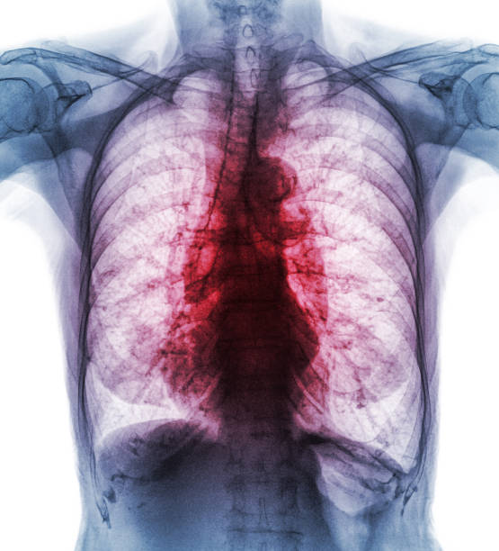 gruźlica płuc . film klatki piersiowej x-ray show śródmiąższowe naciek obu płuc z powodu zakażenia mycobacterium tuberculosis - interstitial zdjęcia i obrazy z banku zdjęć