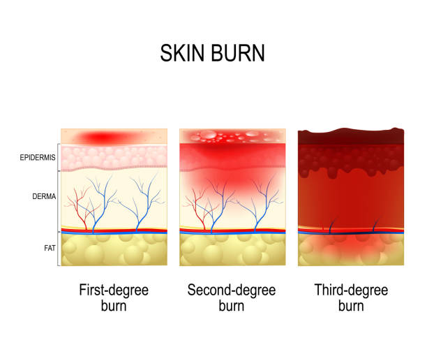 skin burn. Three degrees of burns. skin burn. Three degrees of burns. type of injury to skin. step of burn epidermal cell stock illustrations