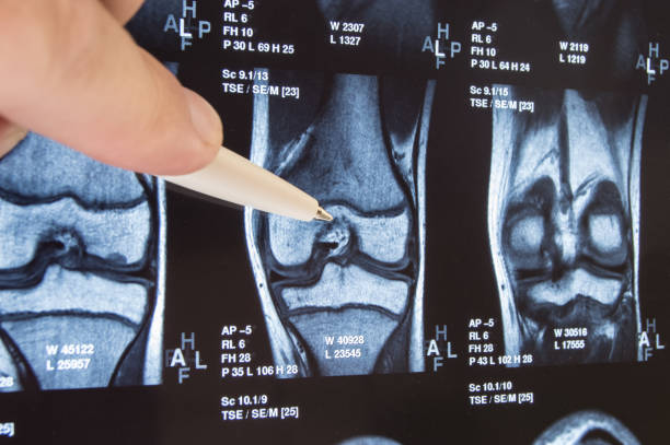 radiografía de articulación de rodilla o mri. médico señaló en área del empalme de rodilla, donde se detecta la patología o problema, dicha fractura, destrucción de la articulación, artrosis. diagnóstico de enfermedades de la rodilla por radiología - rheumatic fotografías e imágenes de stock