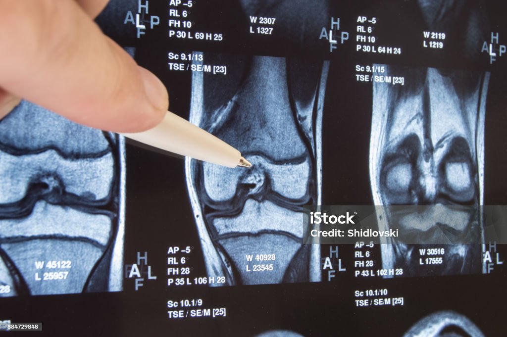 X-ray conjointe du genou ou une IRM. Docteur pointé sur la zone de l’articulation du genou, où pathologie ou un problème est détecté, telle fracture, destruction de l’arthrose en collaboration. Diagnostic des maladies du genou de radiologie - Photo de Genou libre de droits