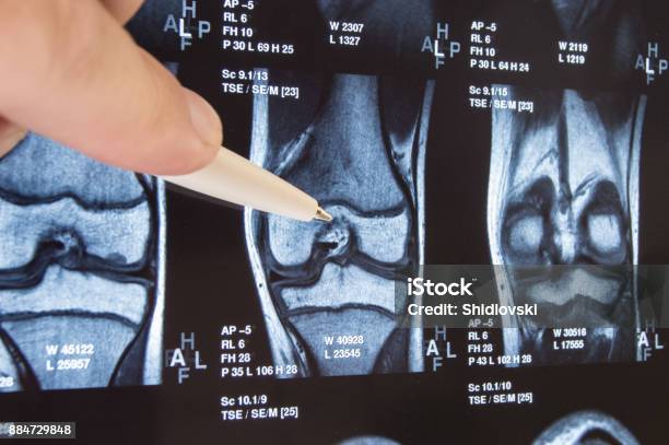 Foto de Raiox Comum Do Joelho Ou Ressonância Magnética Médico Apontou Na Área Da Articulação Do Joelho Onde A Patologia Ou Problema For Detectado Tal Fratura Destruição Da Articulação Osteoartrite Diagnóstico De Doenças Do Joelho Por Radiologia e mais fotos de stock de Joelho - Perna