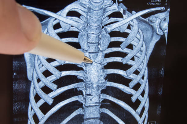 стернум и вилочковая железа. врач указывает на шариковую ручку на грудине и расположение вилочковой железы как органа иммунной и лимфатиче - тимус стоковые фото и изображения