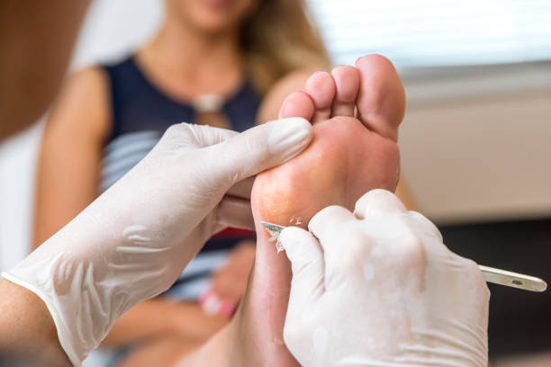 fußpflegerin entfernt haut auf eine warze - podiatrist stock-fotos und bilder