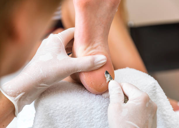 хироподист у�даляет кожу на бородавке - podiatrist podiatry pedicure chiropodist стоковые фото и изображения