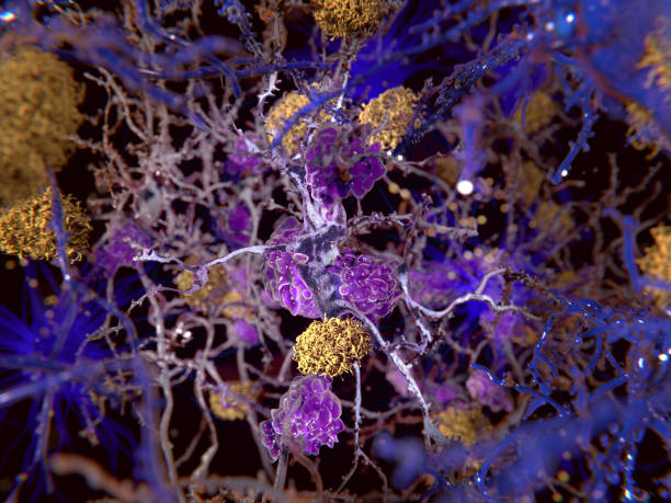 alzheimers sjukdom - amyloid bildbanksfoton och bilder
