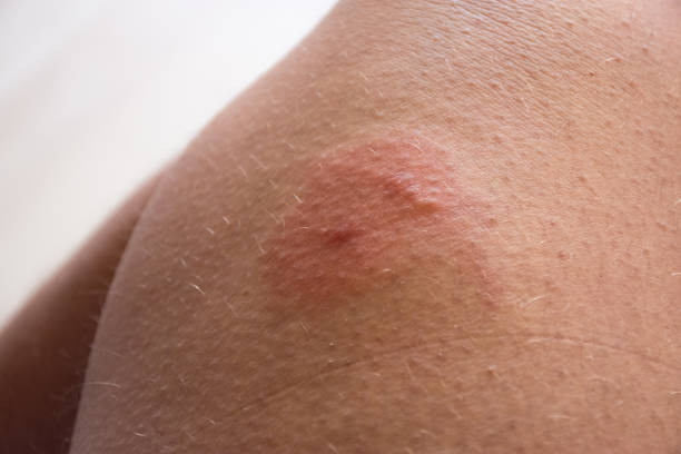 photo of insect bite on skin. double  insect bite (bee,wasp,horsefly) with redness, inflammation area and allergic swelling or edema on human skin. signs and symptoms of skin lesions using bug stings - horse fly imagens e fotografias de stock