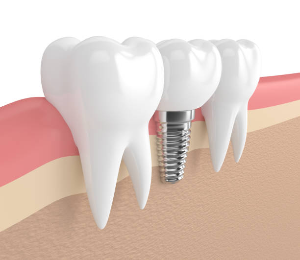istock 3d render of teeth with dental implant in gums 884816242