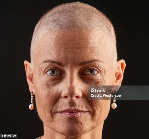 Bald Woman In Chemotherapy With Cancer Losing Hair Stock Photo - Download Image Now - Cancer - Illness, Patient, Portrait - iStock Bald Woman In Chemotherapy With Cancer Losing Hair Stock Photo - Download Image Now - Cancer - Illness, Patient, Portrait - iStock