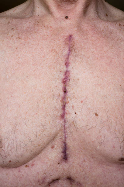 Chest scars one month after heart surgery Shows where sternum was cut and chest drains were inserted in a 66 year old male after open heart surgery heart surgery photos stock pictures, royalty-free photos & images
