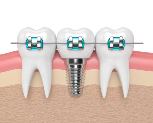 istock 3d render of teeth with implant and braces 885814926