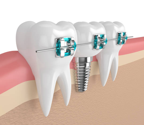 istock 3d render of teeth with implant and braces 885815038