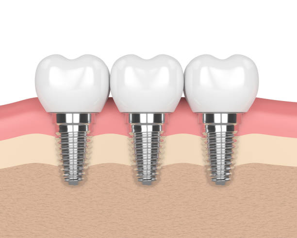 istock 3d render of dental implants in gums 885815448