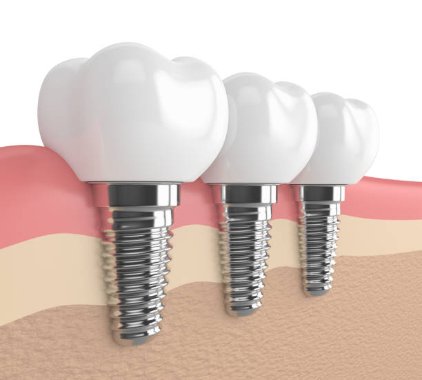 istock 3d render of dental implants in gums 885819730