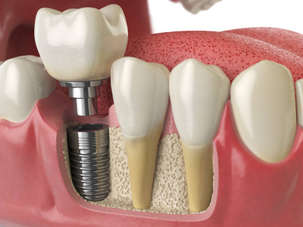 anatomía de los dientes sanos y dientes implantes dentales en denturra humano. - teeth implant fotografías e imágenes de stock