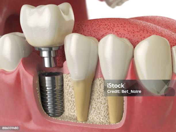 Anatomy Of Healthy Teeth And Tooth Dental Implant In Human Denturra Stock Photo - Download Image Now