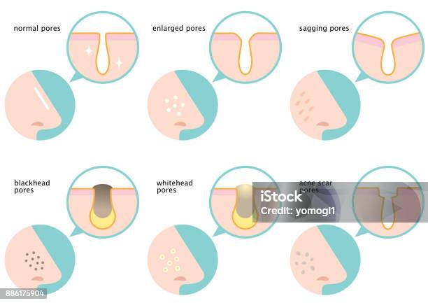 Set Of Skin Pores On Nose Normal Sagging Enlarged Blackhead Whitehead And Acne Scar Stock Illustration - Download Image Now
