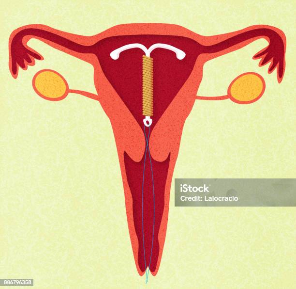 Stérilet Vecteurs libres de droits et plus d'images vectorielles de Stérilet - Stérilet, Personnes féminines, Comportement sexuel