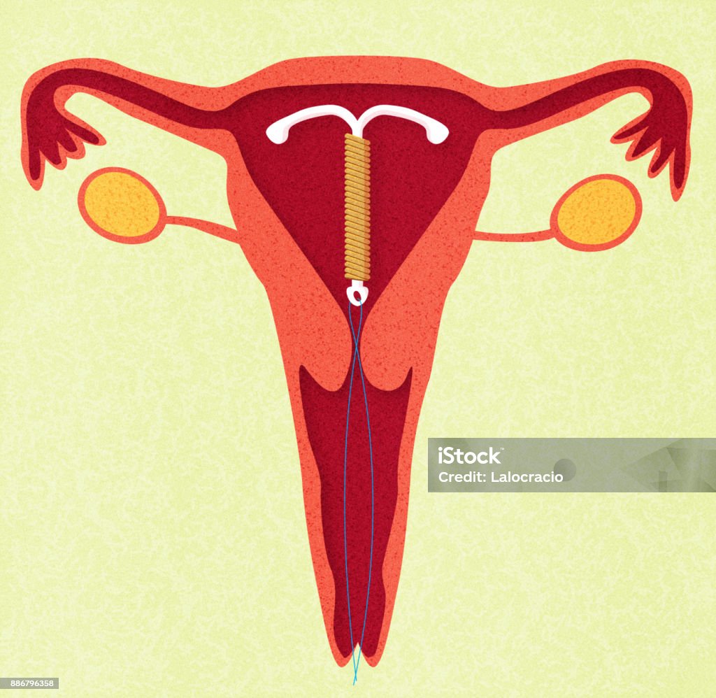 IUD IUD in vagina IUD stock illustration