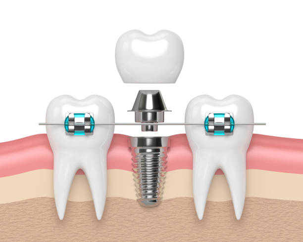 istock 3d render of teeth with implant and braces 887116580