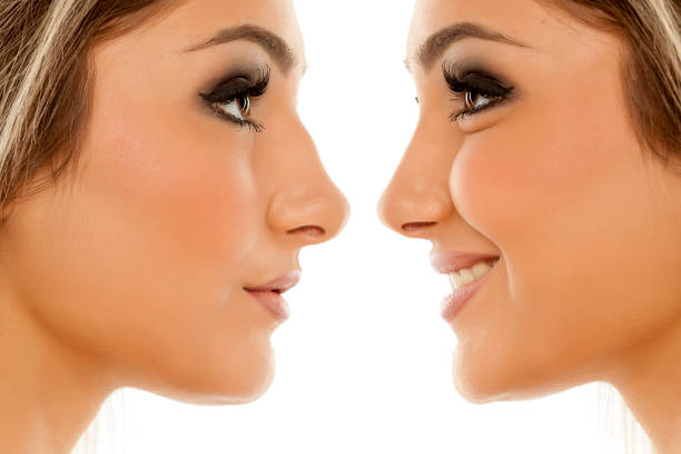 comparison of female nose, before and after plastic surgery - nose job imagens e fotografias de stock