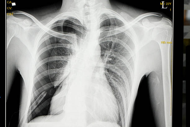 istock Chest X Ray film 888511426