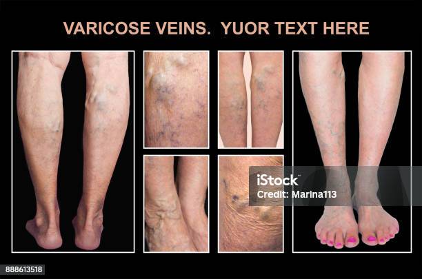 Painful Varicose Veinsspider Veins Varices On A Severely Affected Leg  Ageing Old Age Disease Aesthetic Problem Concept Stock Photo - Download  Image Now - iStock