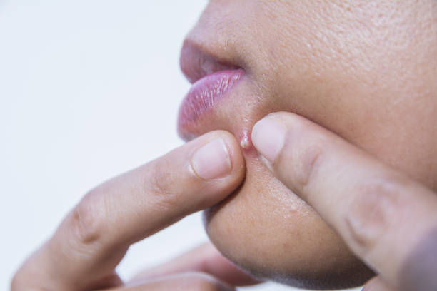 istock Acne on facial skin close up 888652648