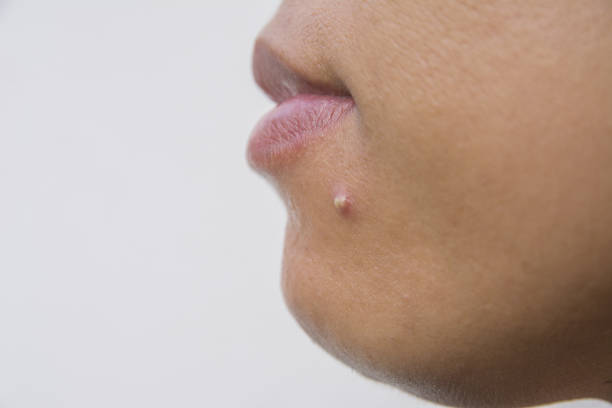 istock Acne on facial skin close up 888653318