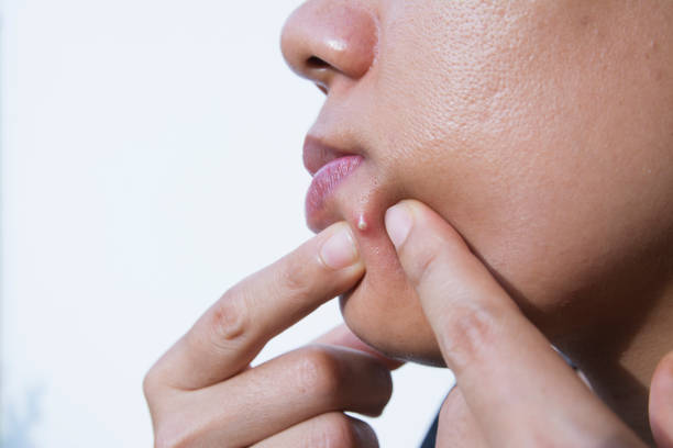 istock Acne on facial skin close up 888653384