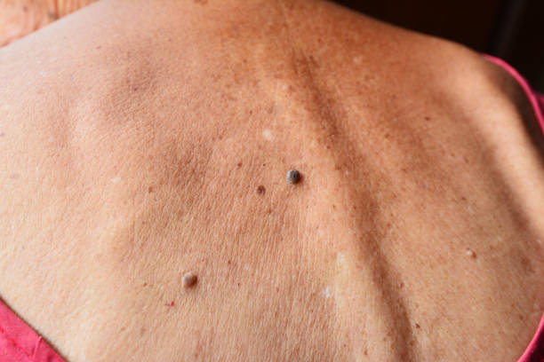 istock Mole on old woman skin 888666418