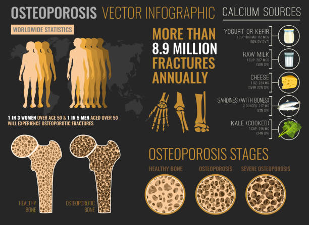osteoporose-infografik-poster - osteoporose stock-grafiken, -clipart, -cartoons und -symbole