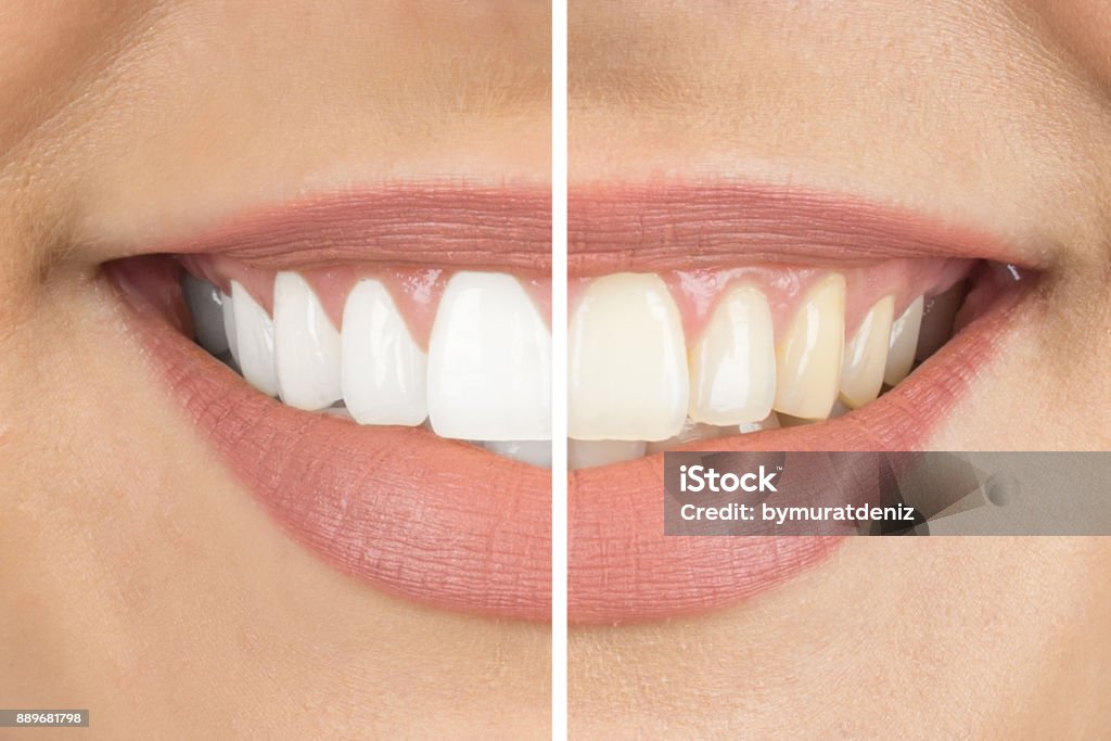 Avant et Après - Photo de Blanchiment des dents libre de droits