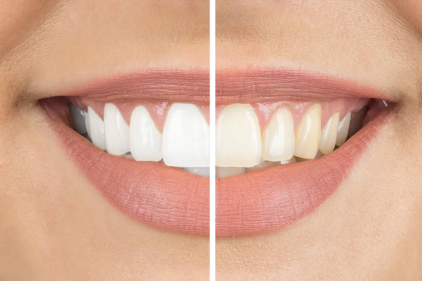 prima e dopo - human teeth whitening dentist smiling foto e immagini stock