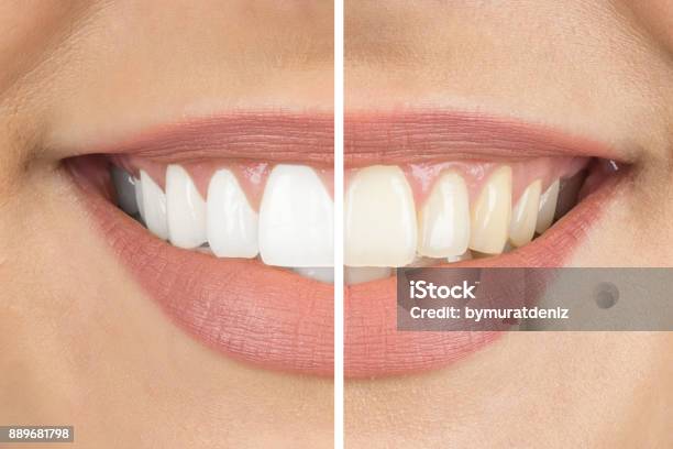 Prima E Dopo - Fotografie stock e altre immagini di Sbiancamento dentale - Sbiancamento dentale, Bianco, Sorridere