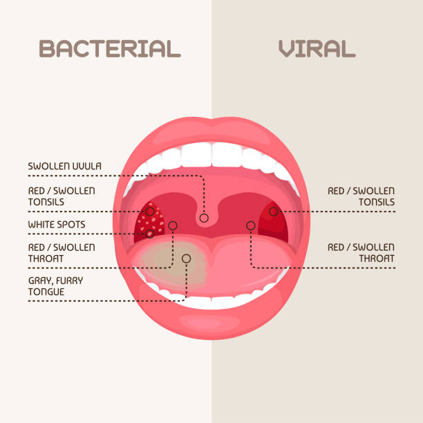 illustrations, cliparts, dessins animés et icônes de infection de la gorge, inflammation des amygdales. - pharyngitis