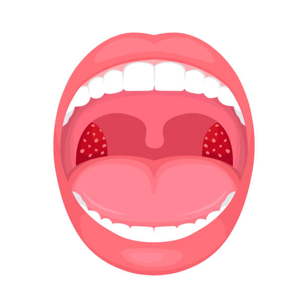 illustrazioni stock, clip art, cartoni animati e icone di tendenza di infezione alla gola, infiammazione delle tonsille. - ugola