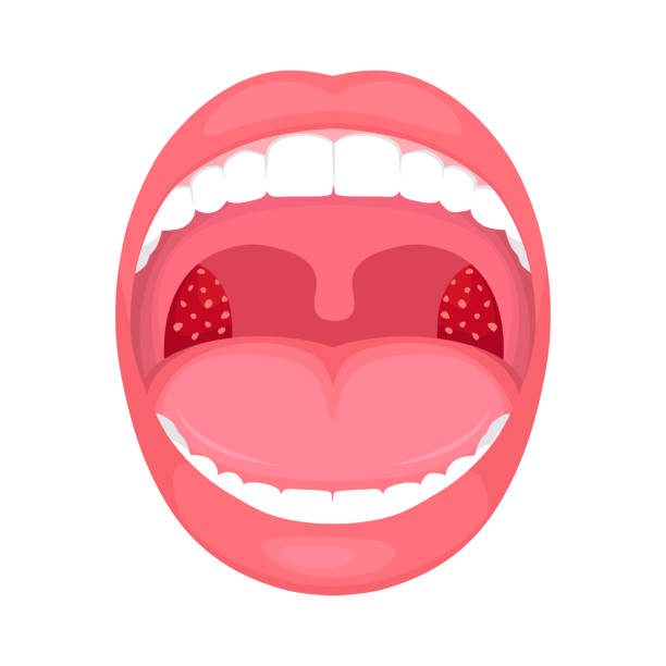 목 구멍 감염, 편도 선 염증입니다. - pharyngitis stock illustrations