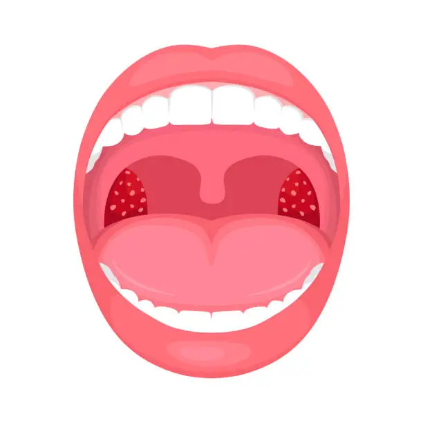 Vector illustration of throat infection, tonsils inflammation.