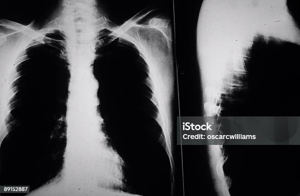 X 레이 Of 흡연가를 폐 X-레이에 대한 스톡 사진 및 기타 이미지 - X-레이, 건강관리와 의술, 내부
