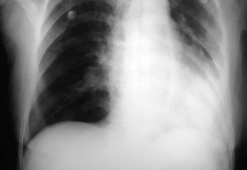La radiografía pulmonar de pneumonic patien photo