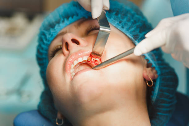 男性プロの歯科医師の外科医が操作を実行するプロセスをクローズ アップ現代のツール装備クリニック光オフィスで女性患者のインプラント歯をインストールします。血と顔に痛み。 - dental light dental equipment hospital professional occupation ストックフォトと画像
