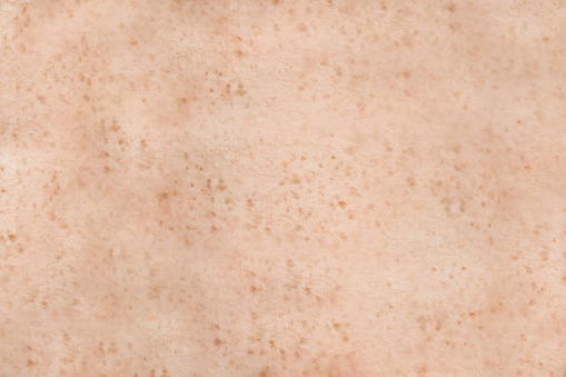 Freckled piel humana photo