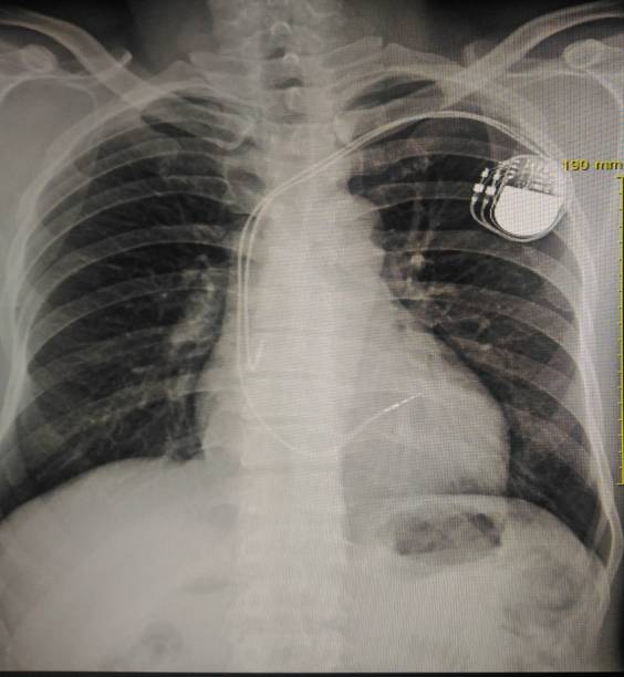 istock X-ray chest showing pacemaker in body chest 894128428