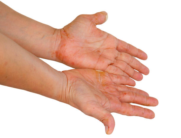 istock hand with a blister caused by allergies isolated on white background: Pompholyx hand 894290426